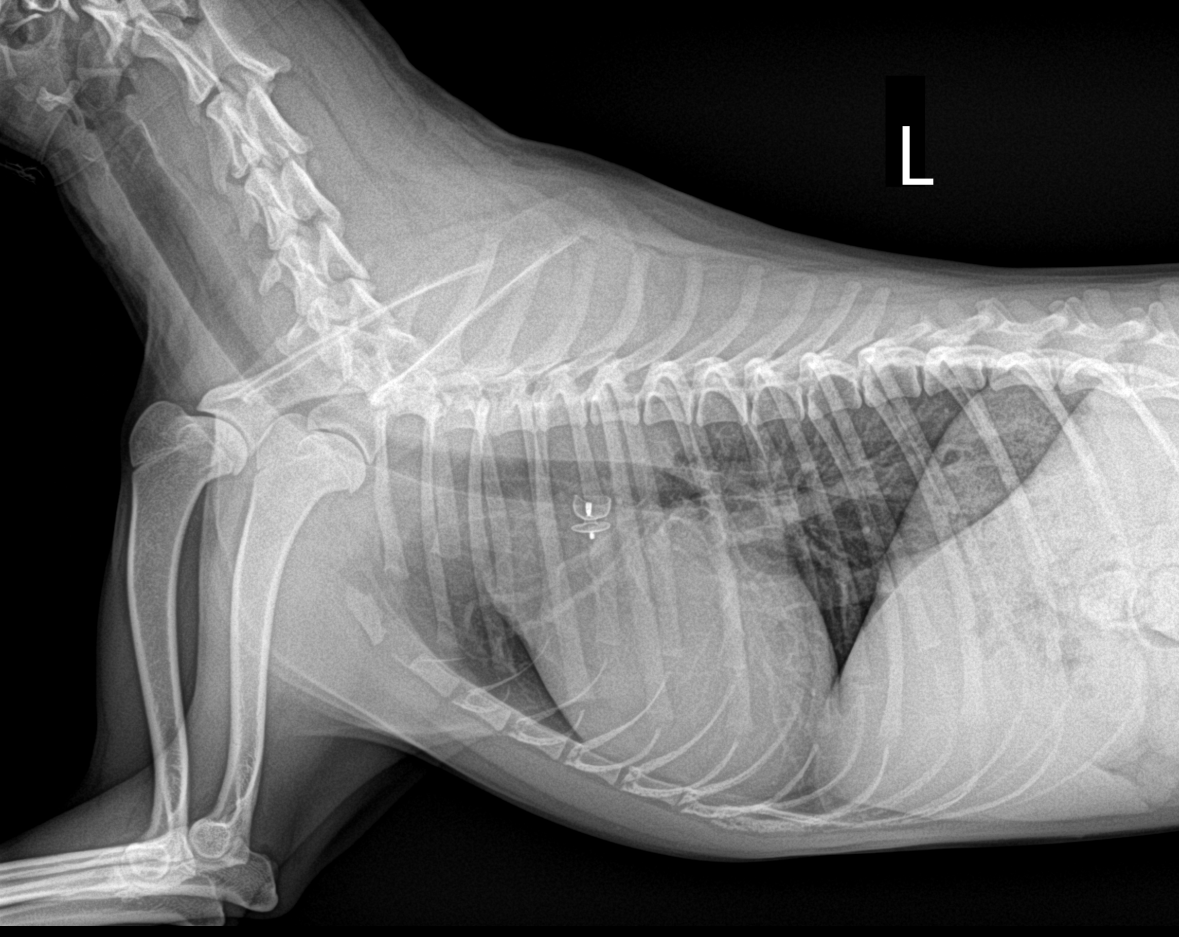 PDA 시술 후 방사선