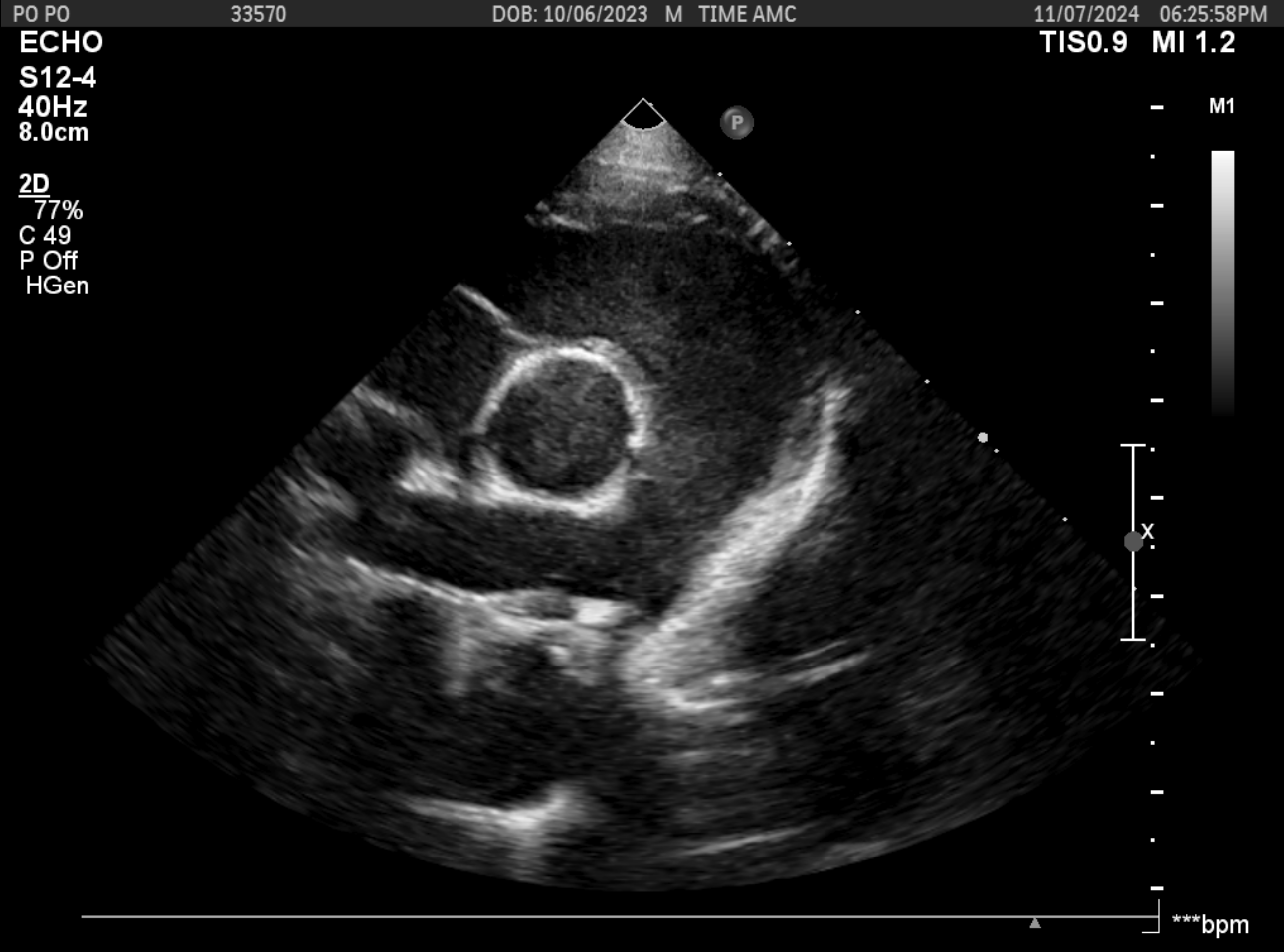 PDA 시술 후 초음파 1