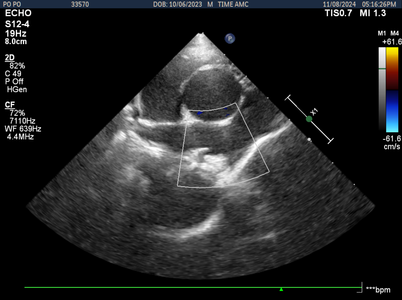 PDA 시술 후 초음파 2