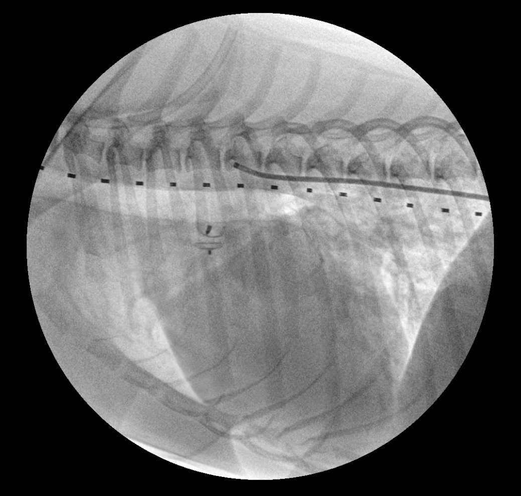 PDA 시술 투시 영상 2