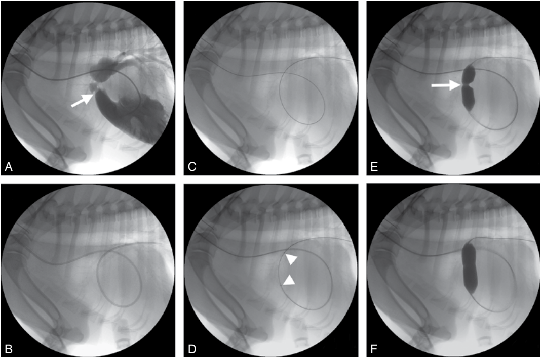 풍선판막성형술 시술 과정
