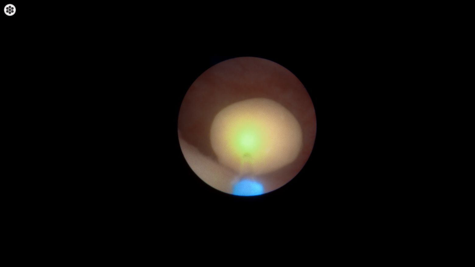 복강경 난소자궁적출술