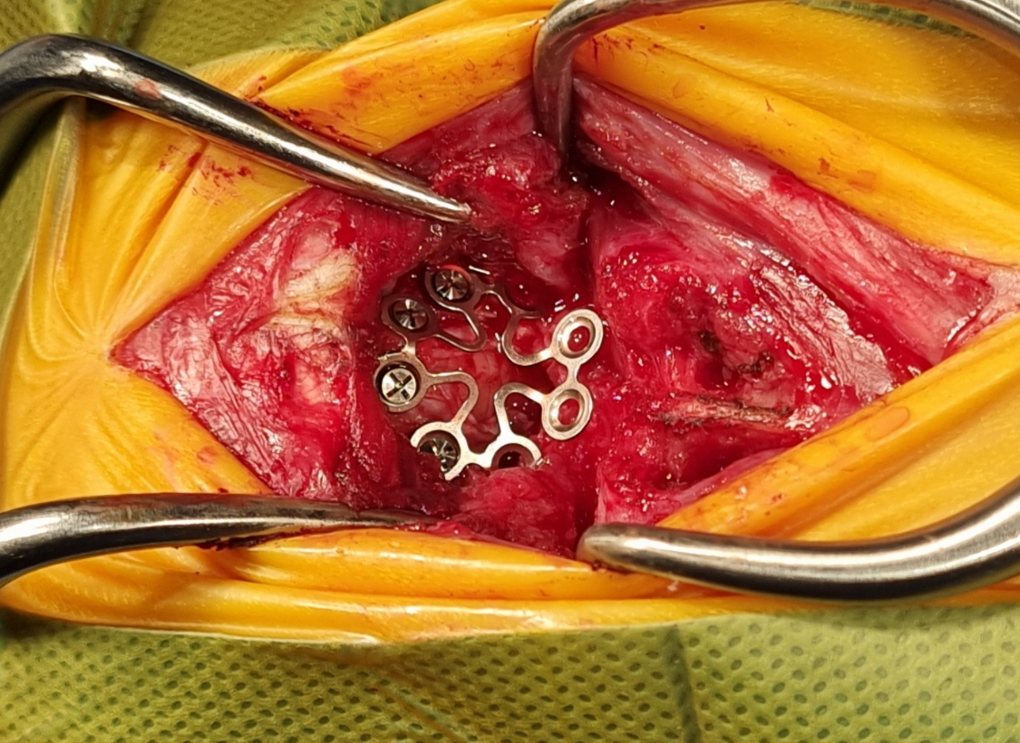 키아리 유사 기형 후두공 감압술